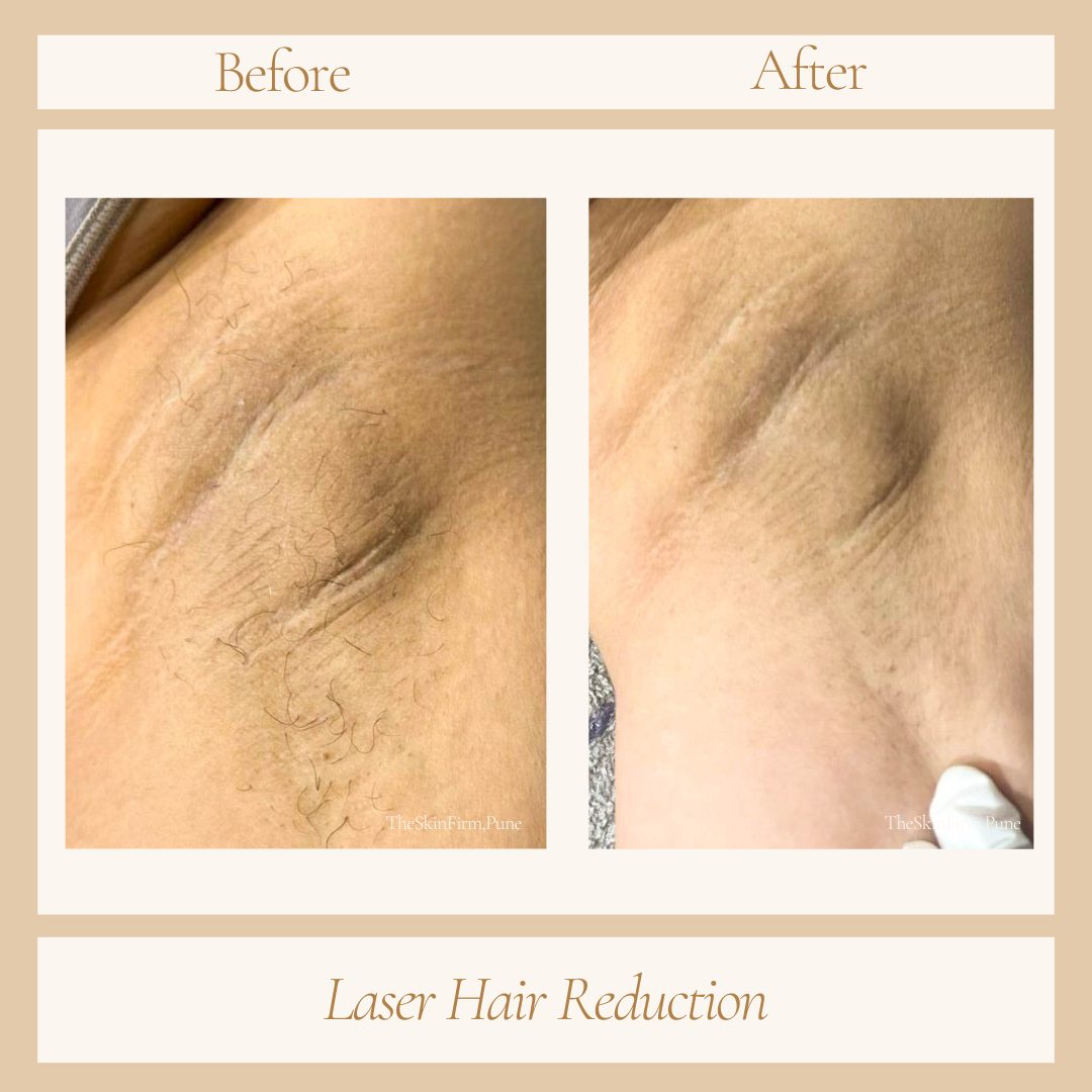 Laser hair removal before and after at Skin Plus