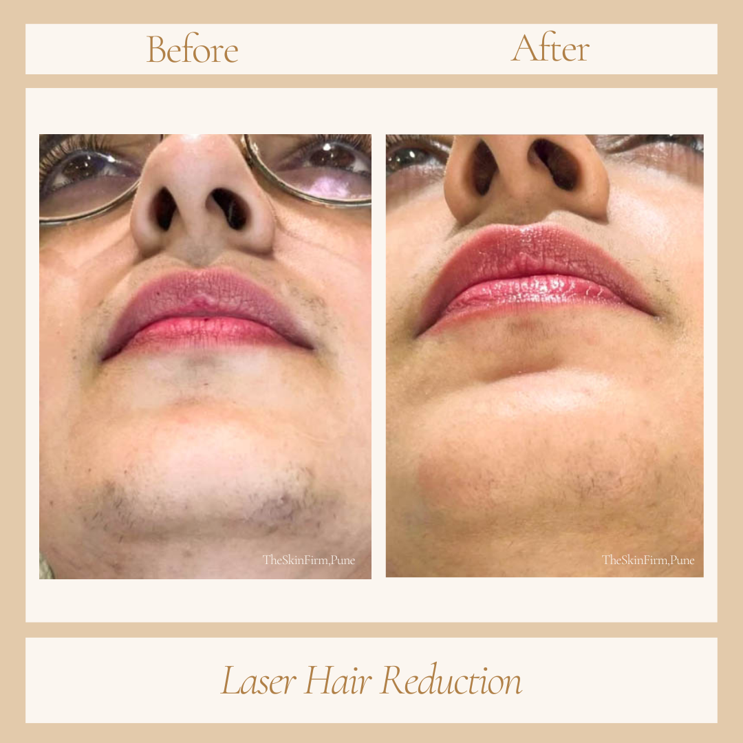 Laser hair removal before and after at Skin Plus