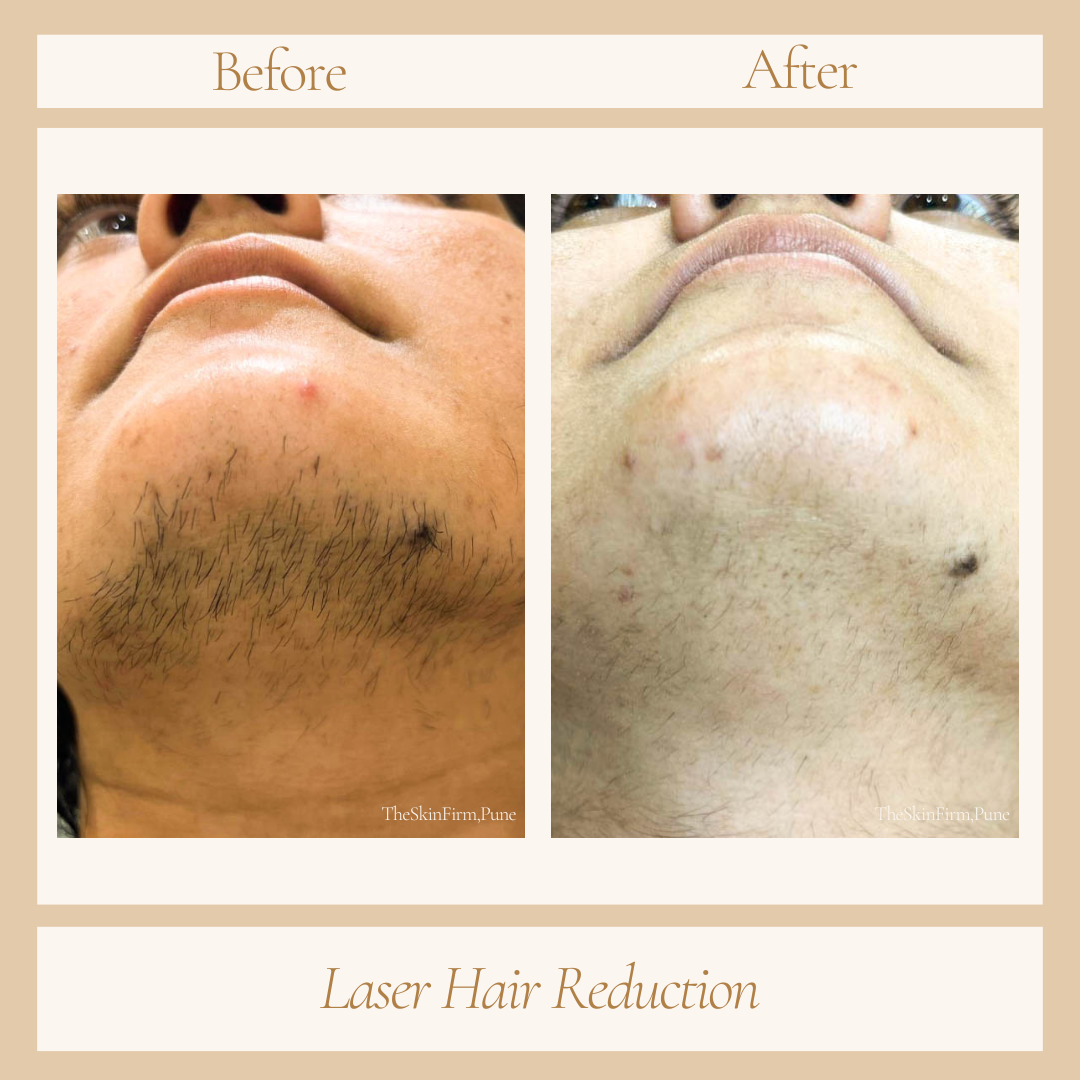 Laser hair removal before and after at Skin Plus